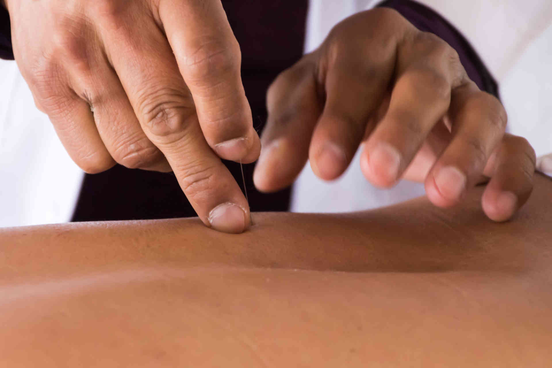 Diplomatura en Terapeuta en Acupuntura