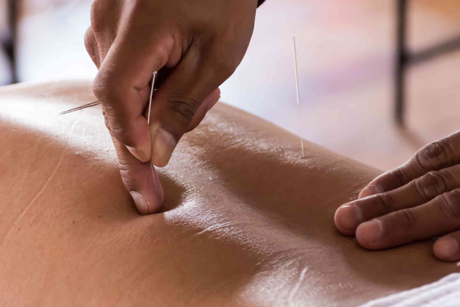 Diplomatura en Terapeuta en Acupuntura