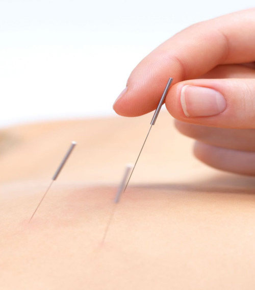 Diplomatura Terapeuta en Acupuntura